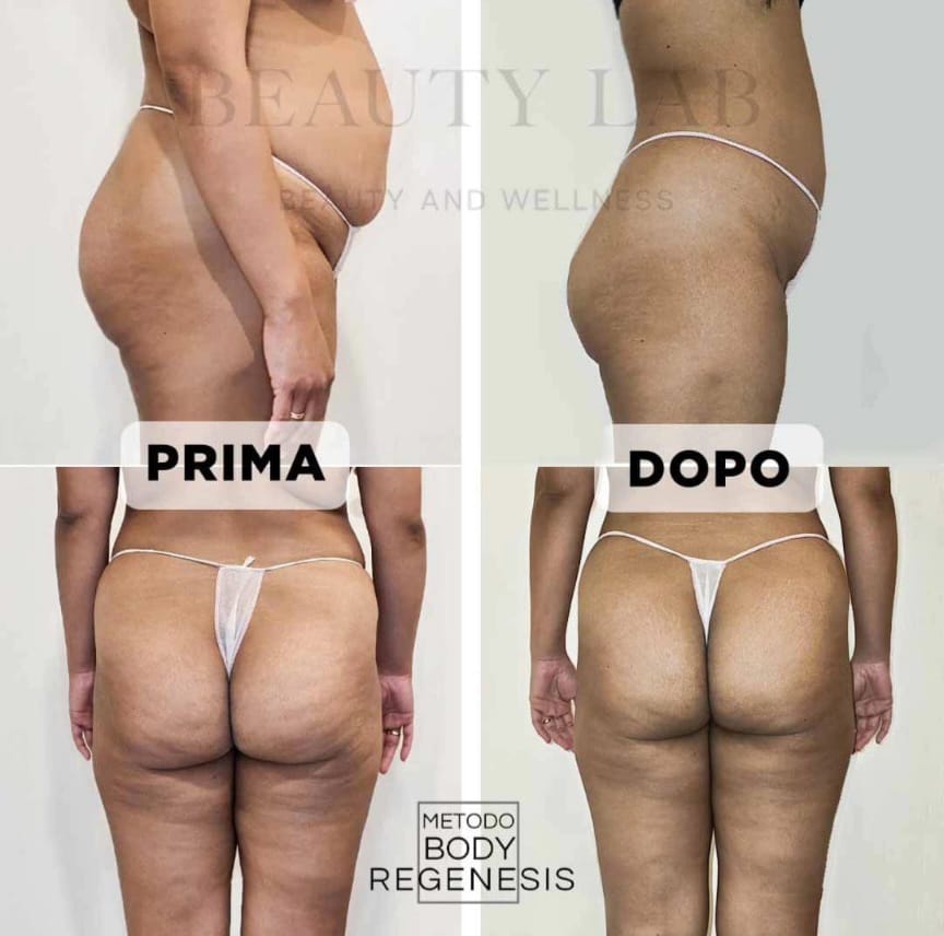 Prima e dopo: rimodellamento di fianchi e glutei con il metodo Body Regenesis