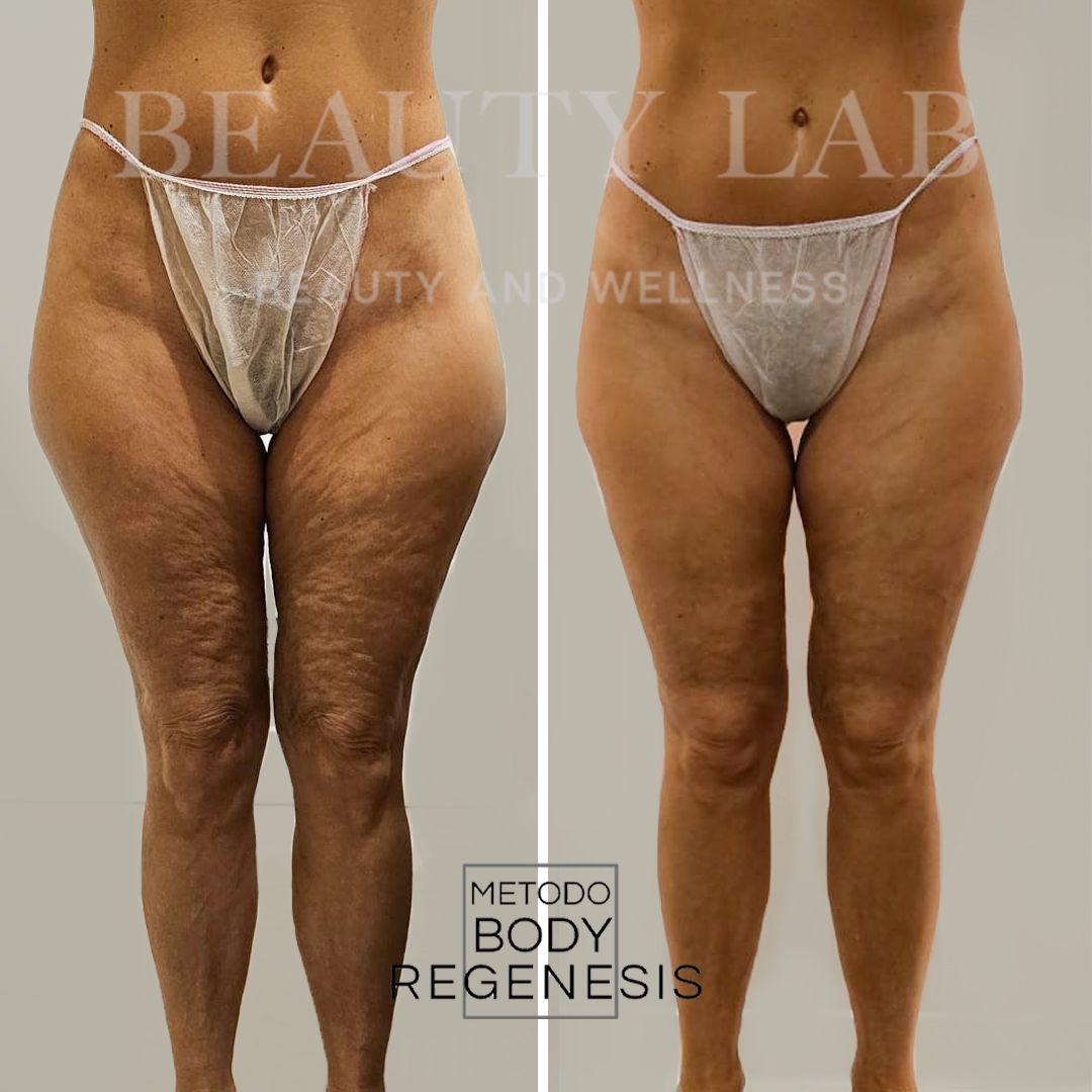 Prima e dopo frontale: miglioramento della cellulite su cosce e glutei