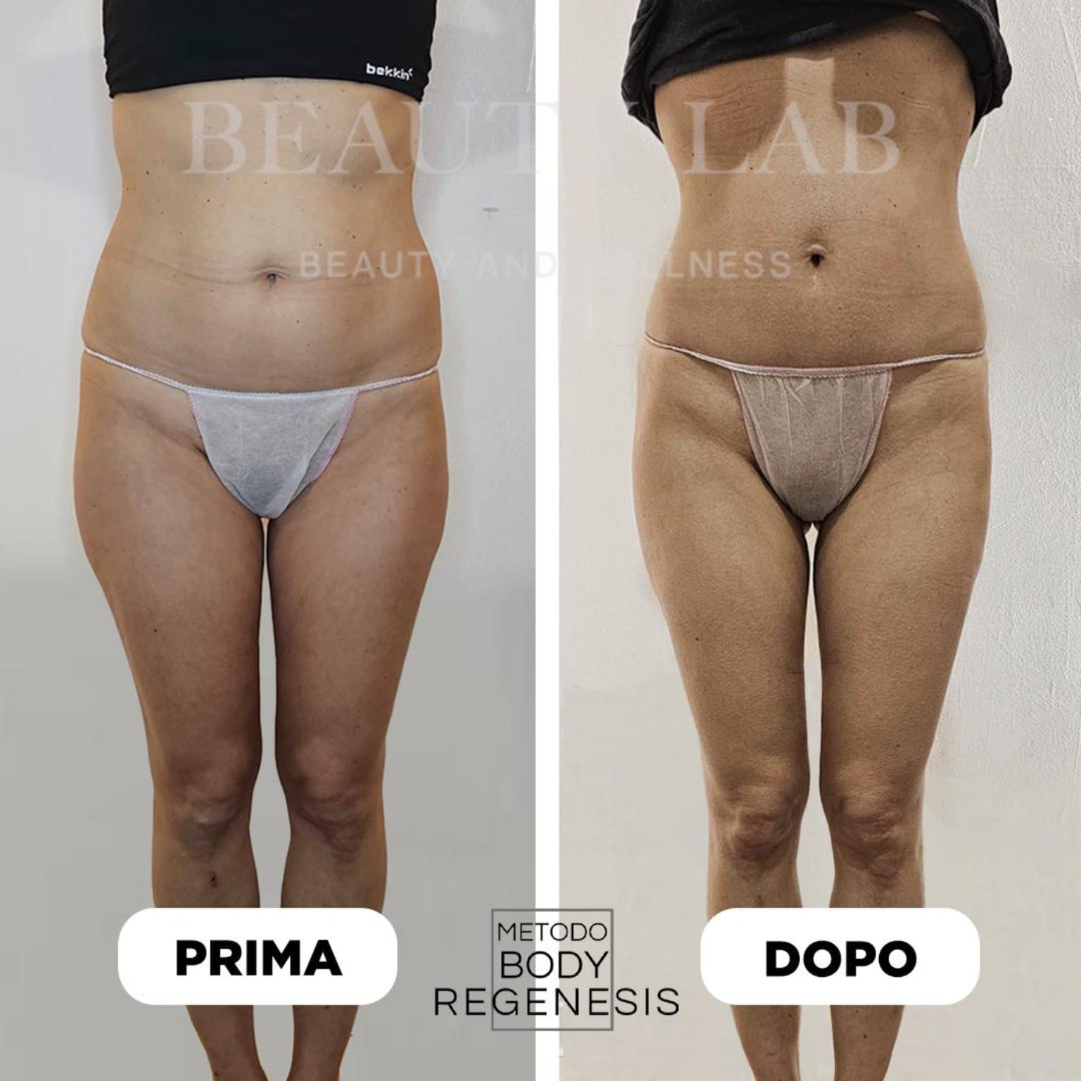 Prima e dopo frontale: riduzione dell'adipe su addome, fianchi e cosce