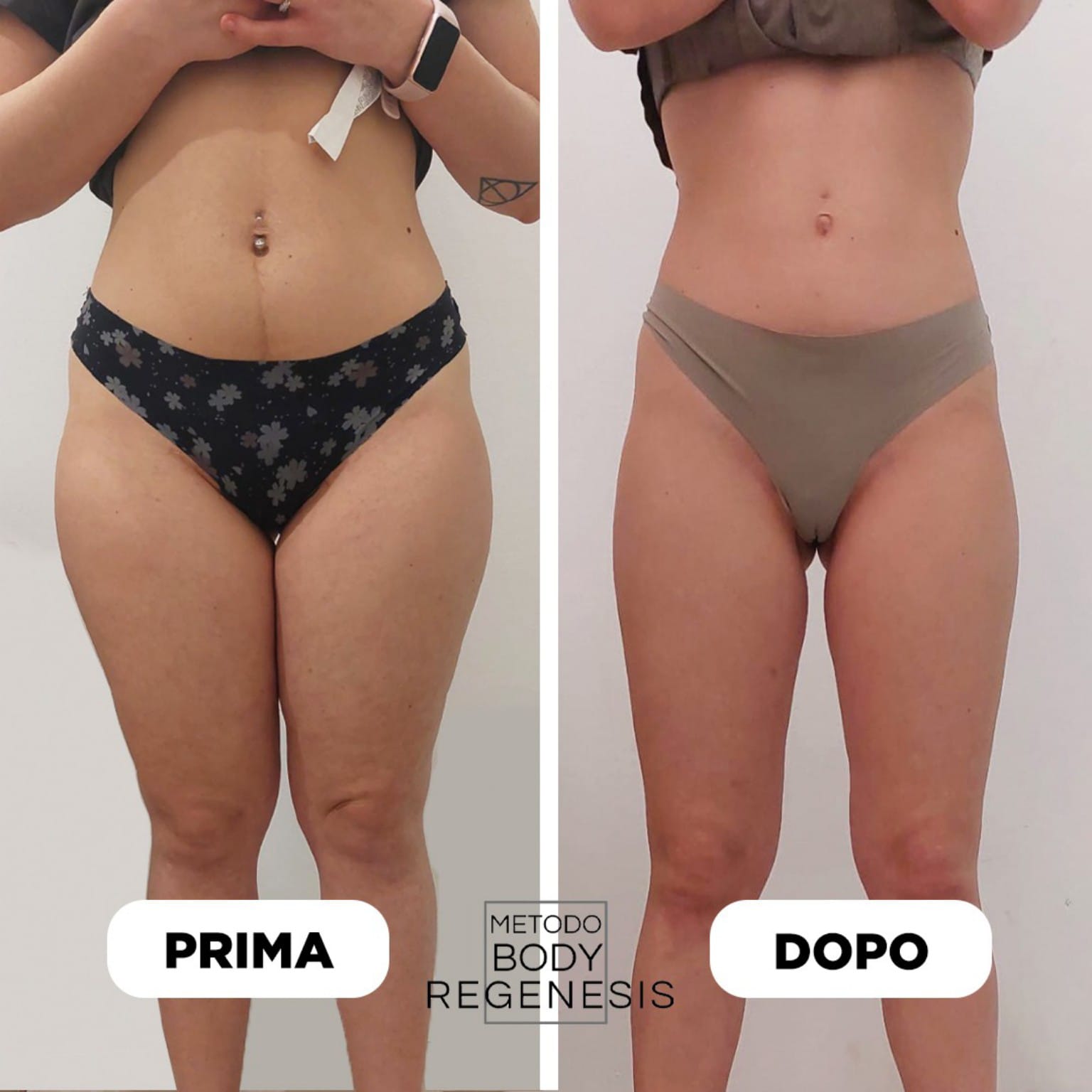 Prima e dopo frontale: addome e cosce dopo il percorso Body Regenesis