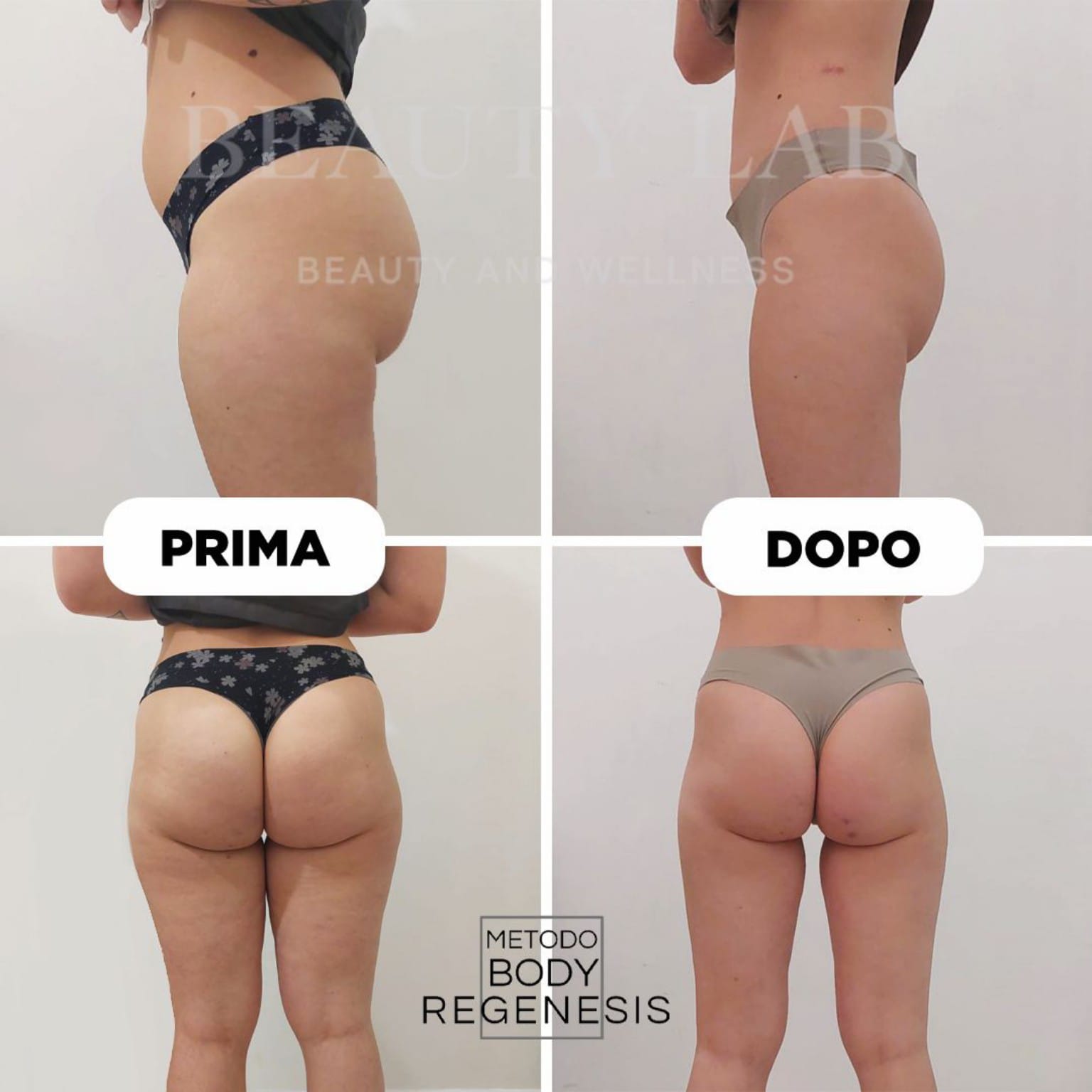 Prima e dopo di profilo e posteriore: glutei e cosce dopo il percorso Body Regenesis